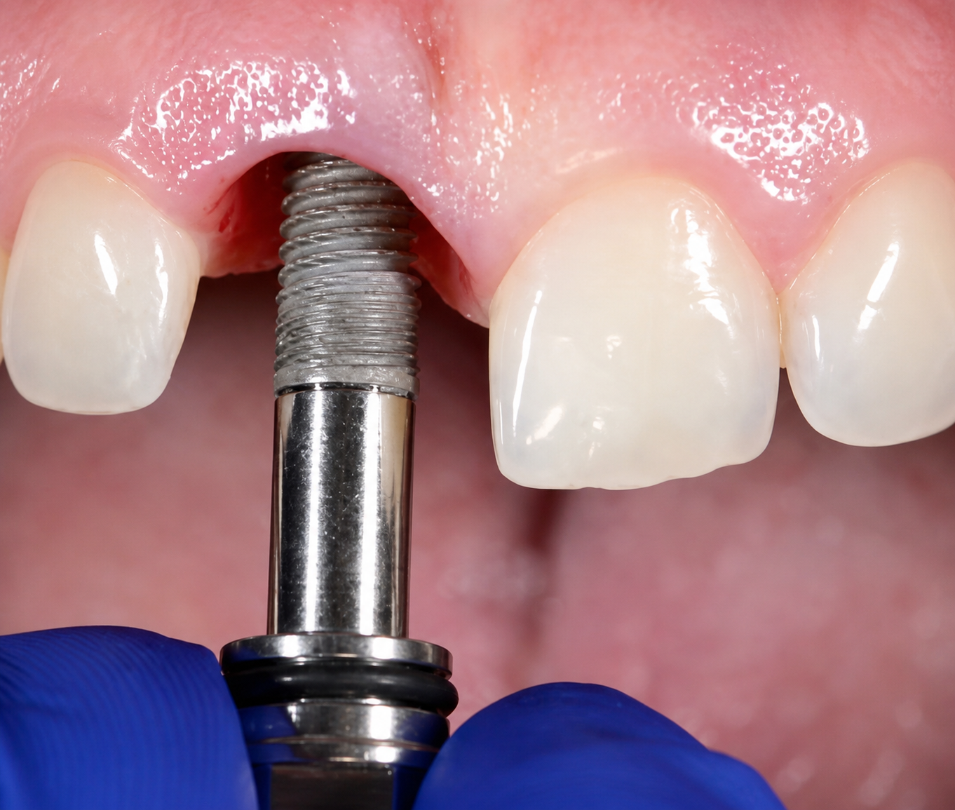 Intensive Dental Implant Training