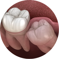 Wisdom Teeth Training