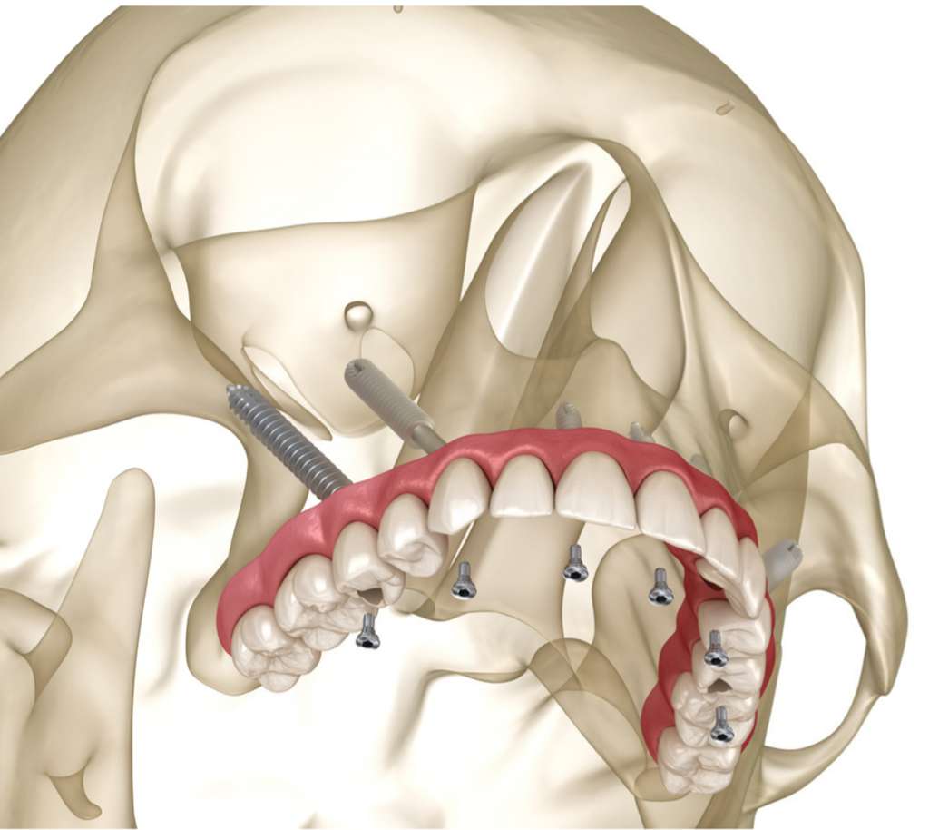 Zygomatic Implant Training