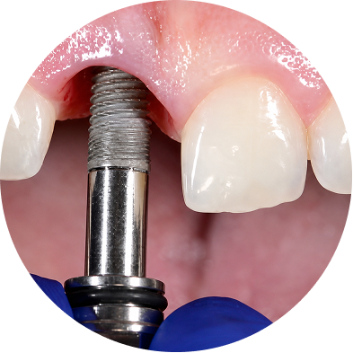 Intensive Dental Implant Training